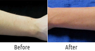 arm laser hair removal delhi