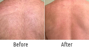 back laser hair removal