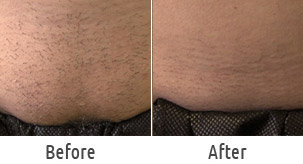 belly laser hair removal