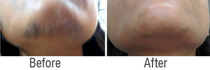 permanent face hair removal