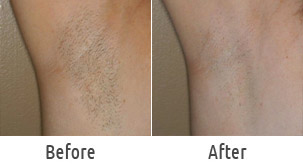 underarms hair removal